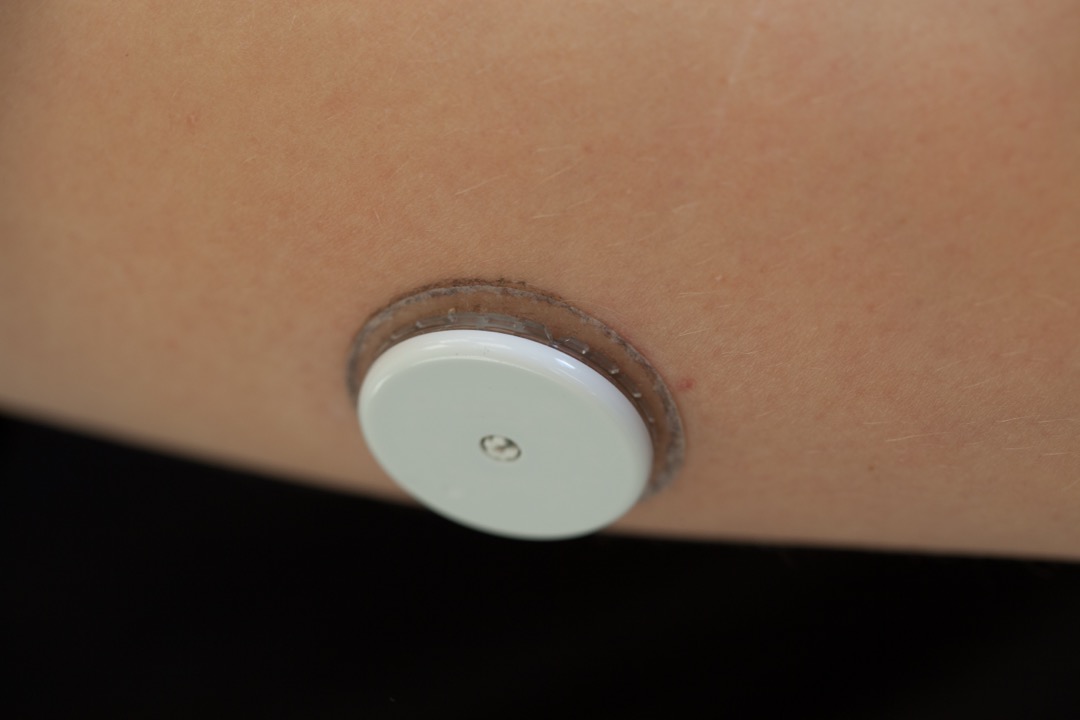 A continuous glucose monitor sensor worn on the back of an upper arm