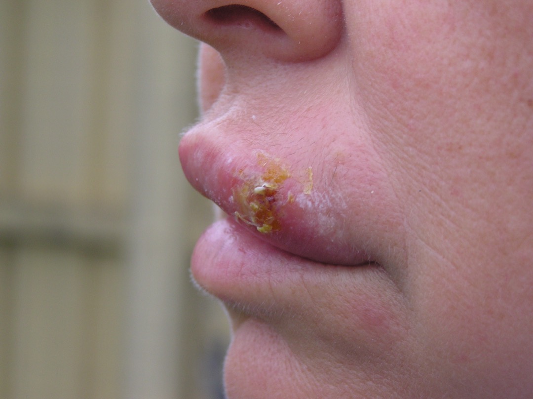 Close-up side view of a cold sore on a person's upper lip at the crusting stage, with a yellow-brown scab over the healed blisters