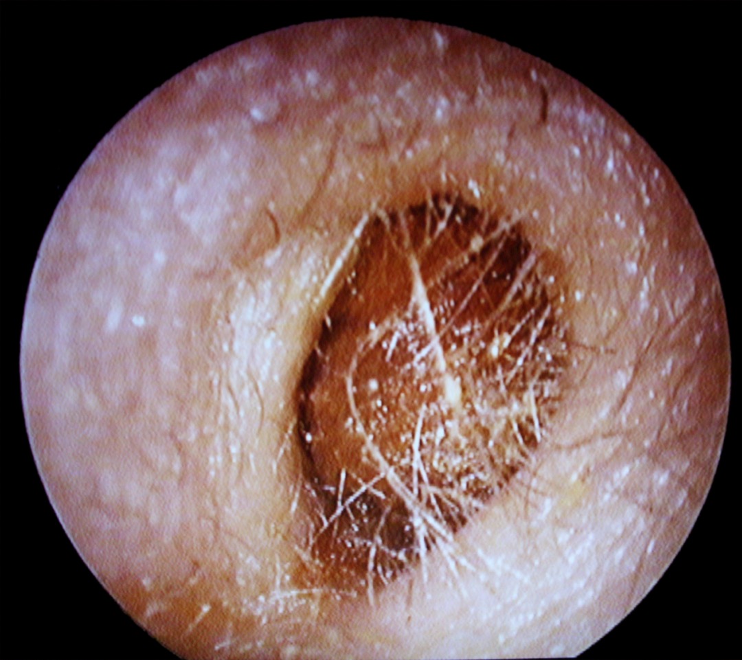 Otoscopic view down a human ear canal showing a brown plug of cerumen partially obstructing the canal in front of the eardrum